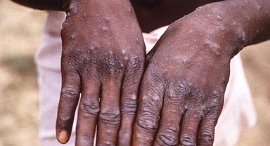 Alarm Verildi! Maymun Çiçeği Vakaları Artışa Geçti