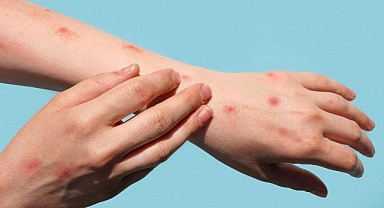 Maymun çiçeği Hastalığı Belirtileri