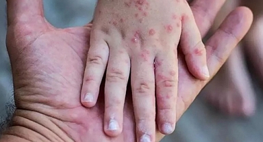 Sağlık Bakanlığı'ndan Maymun Çiçeği Genelgesi