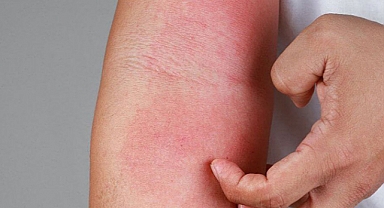 Uzmanlar Uyarıyor: Uyuz Vakaları Arttı